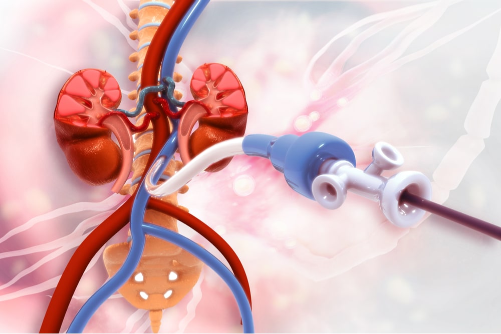 Peripheral artery disease